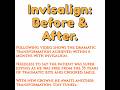 INVISALIGN Transformation (Before & After) इनविज़लाइन - अदृश्य ब्रेसेज़ से मुस्कान बदलें