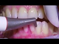 How teeth should be cleaned at the dentist  hygienist