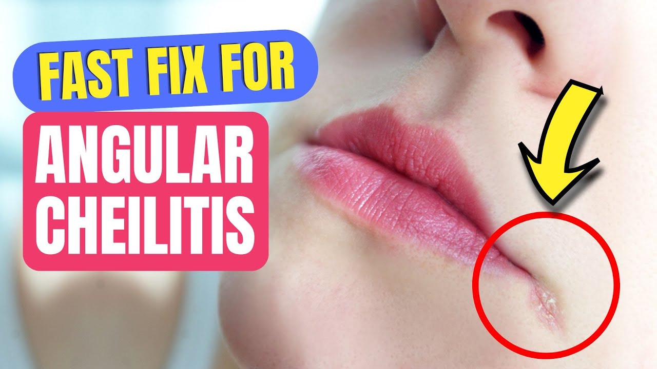 What Causes Angular Cheilitis? Best Treatments That Work 😷