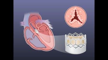 Early TAVR for Asymptomatic Severe Aortic Stenosis | NEJM