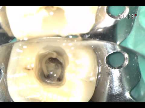 Pus discharge from a root canal in a tooth of AAA