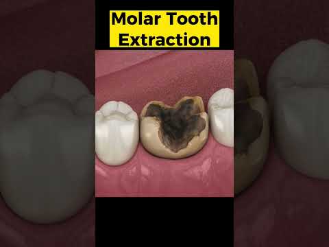 Tooth Extraction 3D Animation #toothextraction #toothdecay