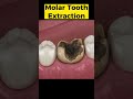 Tooth Extraction 3D Animation #toothextraction #toothdecay