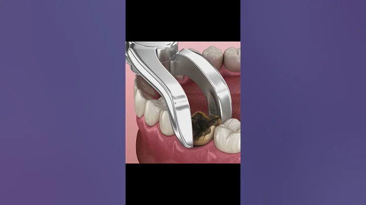 Tooth Extraction 3D Animation #toothextraction #toothdecay - DayDayNews