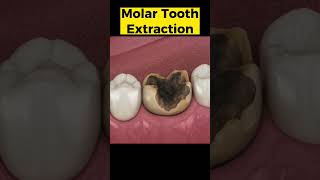 Tooth Extraction 3D Animation #toothextraction #toothdecay