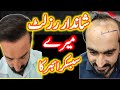 Mere subscriber ka shandar result  hair transplant before and after result 