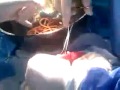 3 year old with intestinal worms emergency surgery