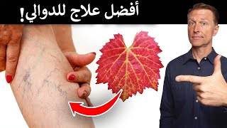 أفضل علاج طبيعي للدوالي (القصور الوريدي)