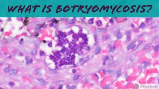 What is Botryomycosis? Hint: it's not fungus! 5-Minute Pathology Pearls Dermatology Dermpath screenshot 2