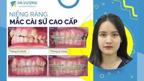 Quá trình thay đổi khi niềng răng mắc cài sứ