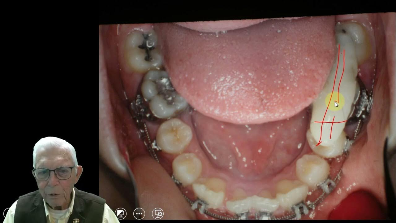 Bonded Blocks Correcting Cross Bites YouTube