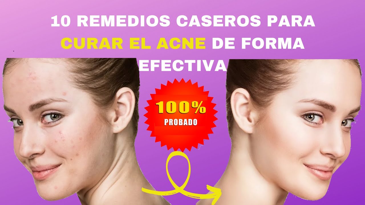 🔥10 Remedios Caseros Para Curar El Acné👩‍⚕️ Youtube