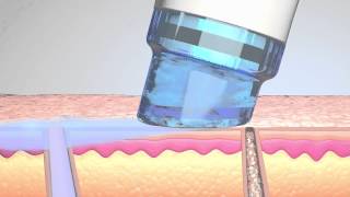 HydraFacial® MD