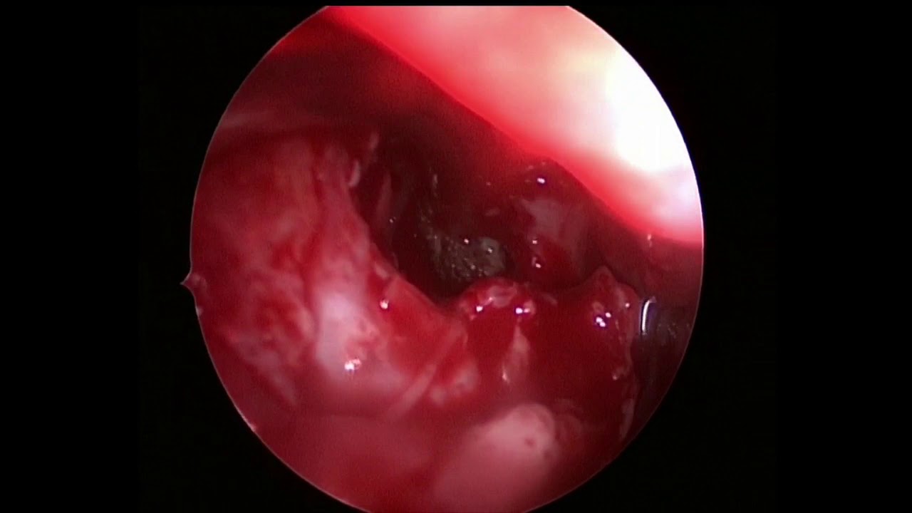Эндоскопическое вскрытие правой верхнечелюстной пазухи