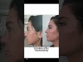 Combining upper eyelid surgery with Ultra clear