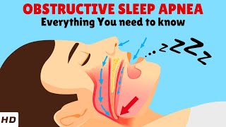 Obstructive Sleep Apnea – Causes, Signs and Symptoms, Diagnosis & Treatment