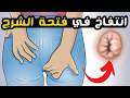 علاج انتفاخ في فتحة الشرج