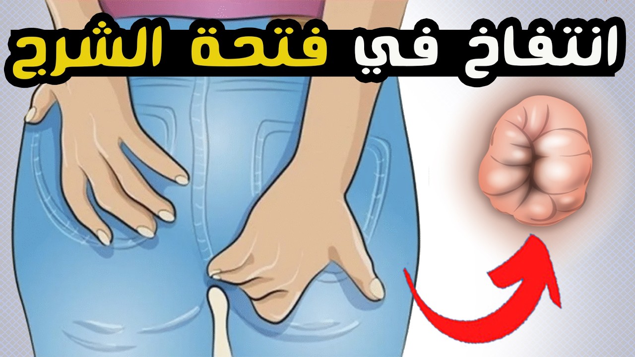 علاج انتفاخ في فتحة الشرج