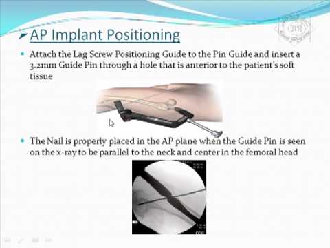 Proximal Femoral Nails