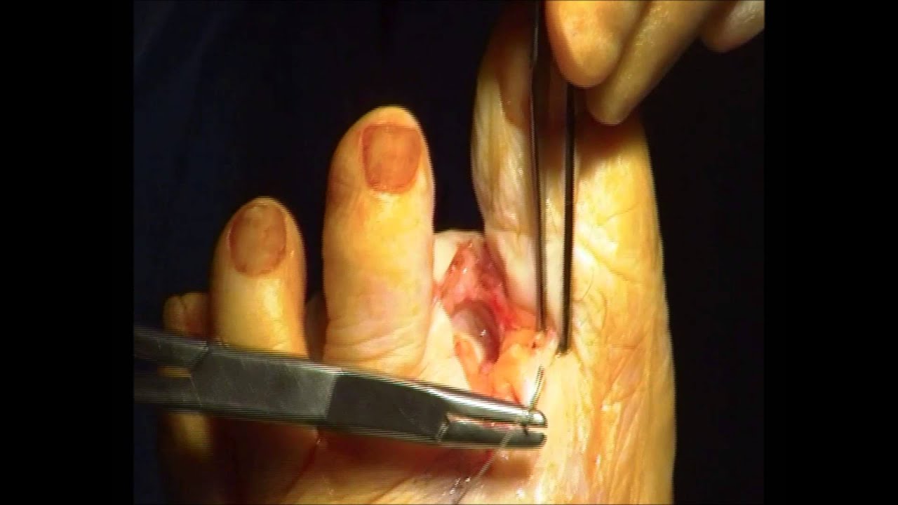 Toe Amputation - YouTube