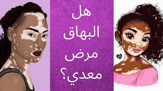 ماهو مرض البهاق وهل هو معدي وايه أسبابة وطرق علاجة #vitiligo