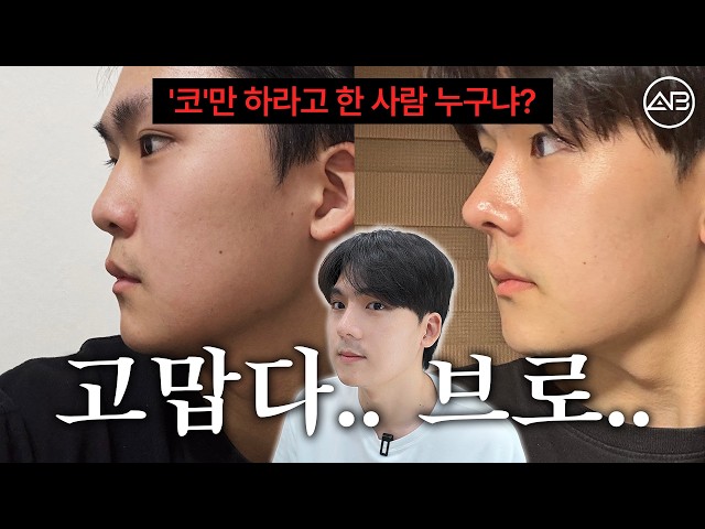20대 남자 첫 코수술🙏 코만 하라고 한 사람 누구예요? 진짜 고맙습니다 | 비포애프터⭕| 에이비성형외과
