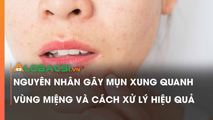 Làm sao đề hết nổi mụn quanh miệng?