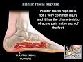 Rupture of the  Plantar Fascia  - Everything You Need To Know - Dr. Nabil Ebraheim