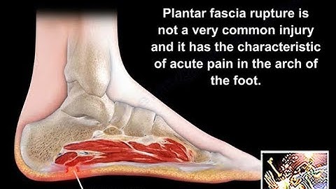 Rupture of the  Plantar Fascia  - Everything You Need To Know - Dr. Nabil Ebraheim