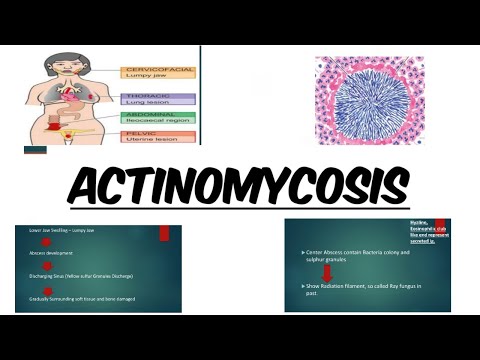 Video: Actinomycosis - Aktinomikosis Oral, Gejala Dan Rawatan