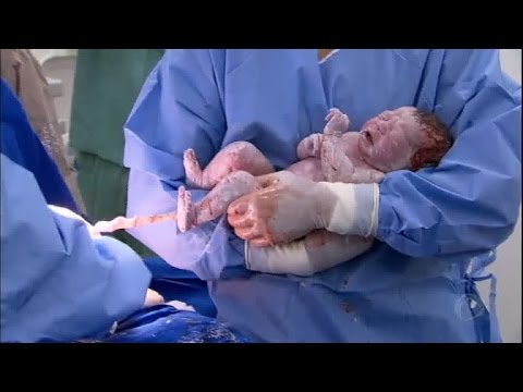 Vídeo: O que acontece quando o cordão umbilical é cortado muito curto?