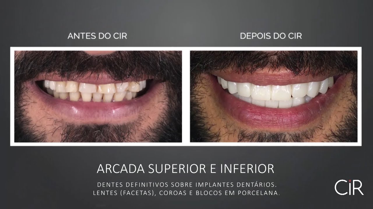 Quanto Tempo Depois Do Implante Pode Colocar O Dente Provisório Quanto Tempo Depois Do Implante Pode Colocar O Dente Provisório