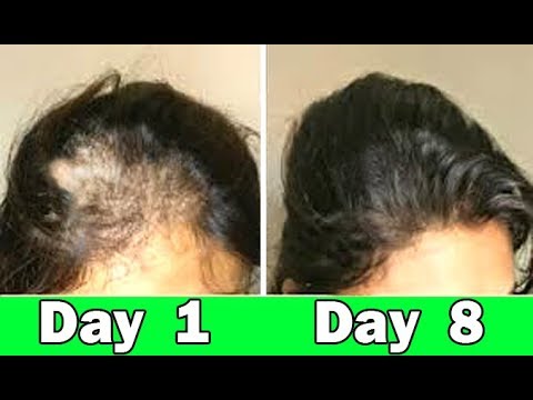 She turned her Thin hair to Thick hair in 1 week - Fenugreek Seeds oil for Hair Growth, Long hair