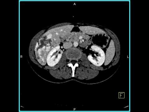 Abdomen: Liver: Cavernous Hemangioma of the Liver(5 of 9)