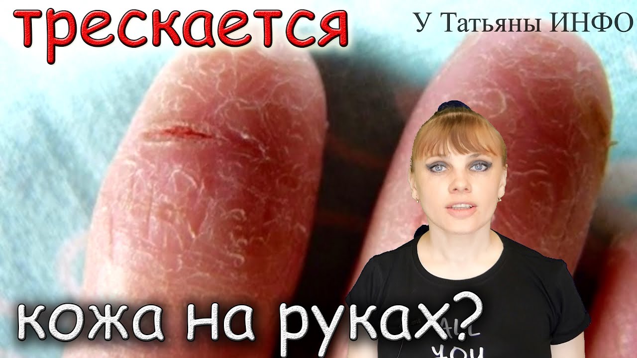 Почему трескается кожа на руках?