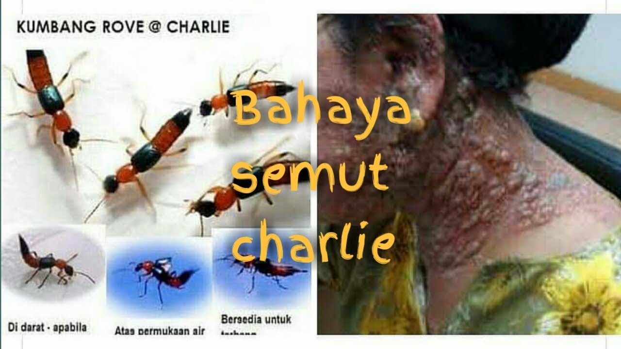 Charlie kesan gigitan binatang charlie…….