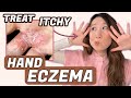 How to treat hand eczema  dr joyce dermatologist