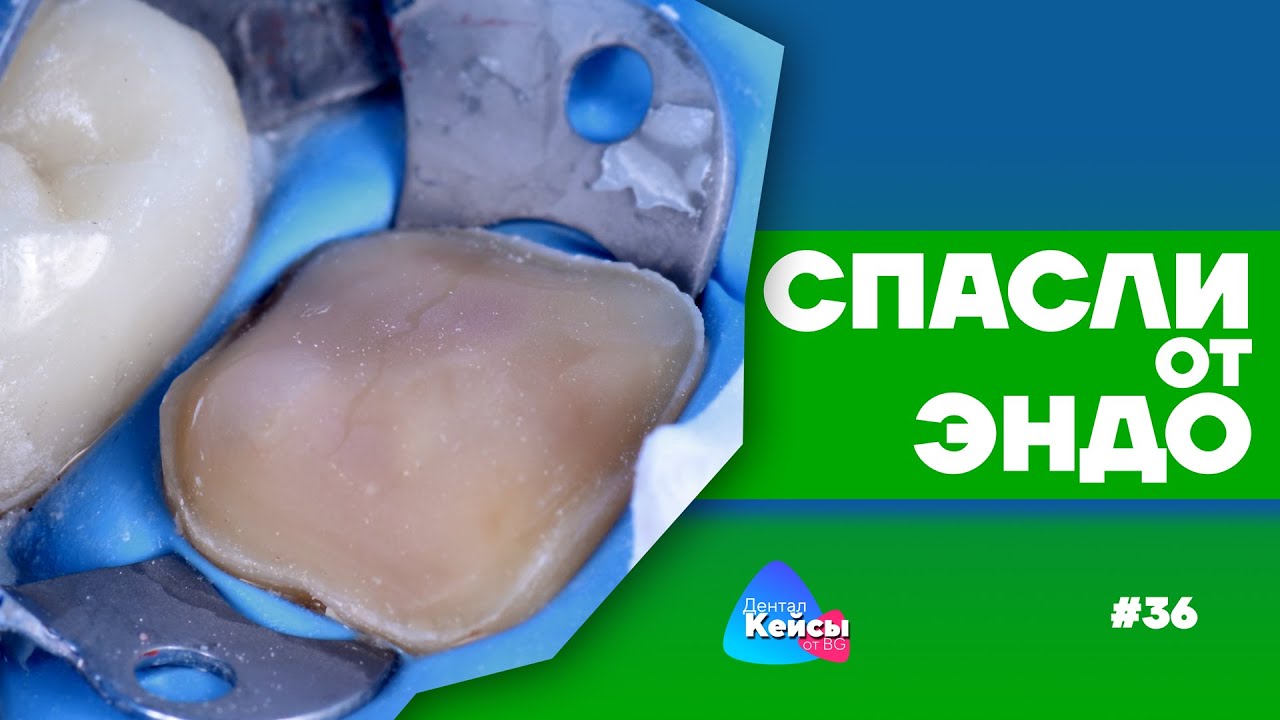 Спасли от эндо | Дентал Кейсы от BG #36