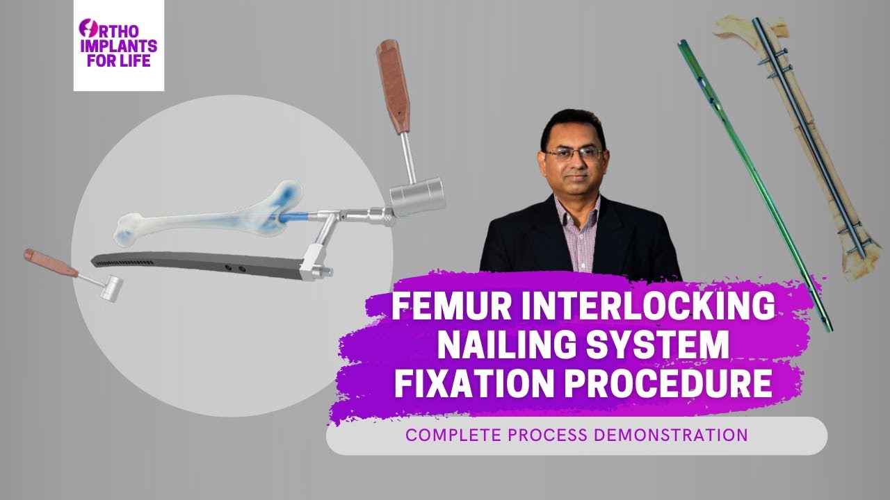 Proximal Femur Nail Antirotation (PFNA)