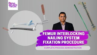 Femur Interlocking Nailing System | Fixation Procedure