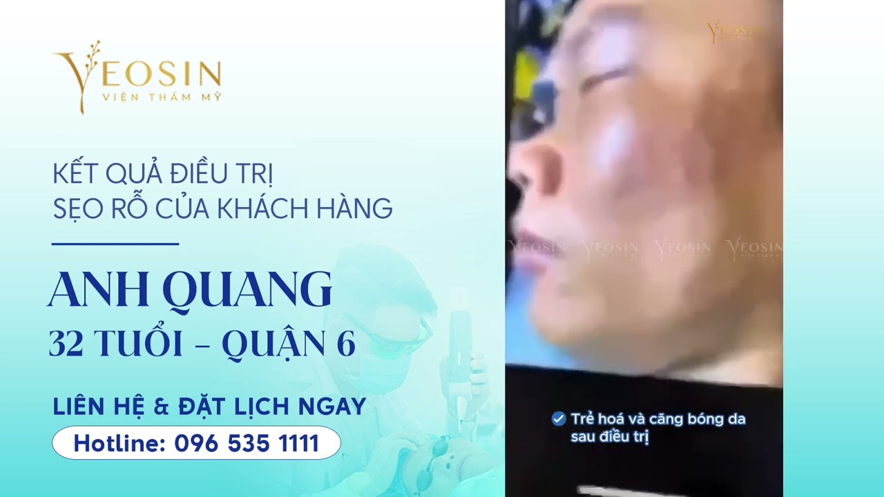 Điều trị sẹo rỗ hiệu quả bằng công nghệ Filling Scars 20 YouTube video