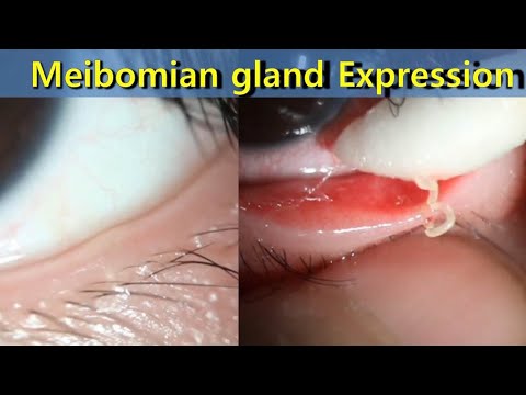Meibomian gland Expression