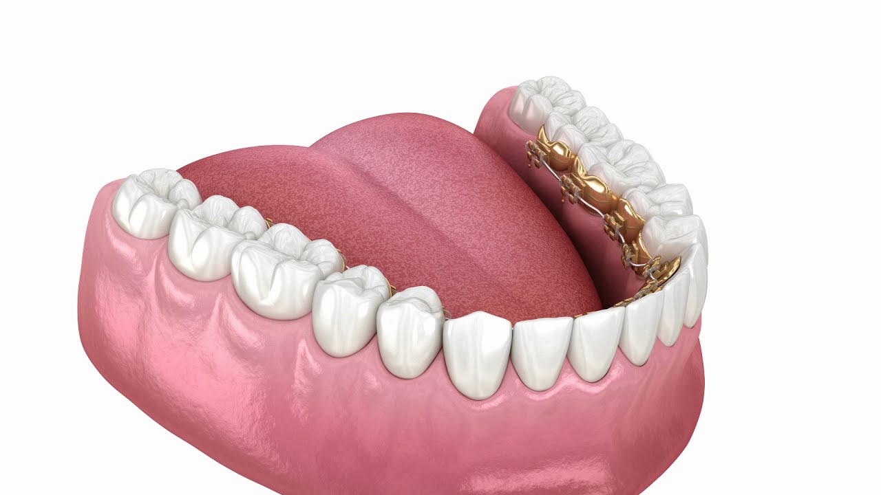 Как ставят брекеты - YouTube