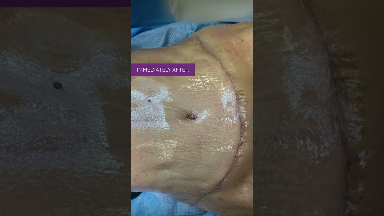 Diastasis Repair during Tummy Tuck by Dr. Erick Sanchez