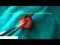 SEBACEOUS CYST Wtf Barbara A Lamm SEBACEOUS CYST Wtf Barbara A Lamm
