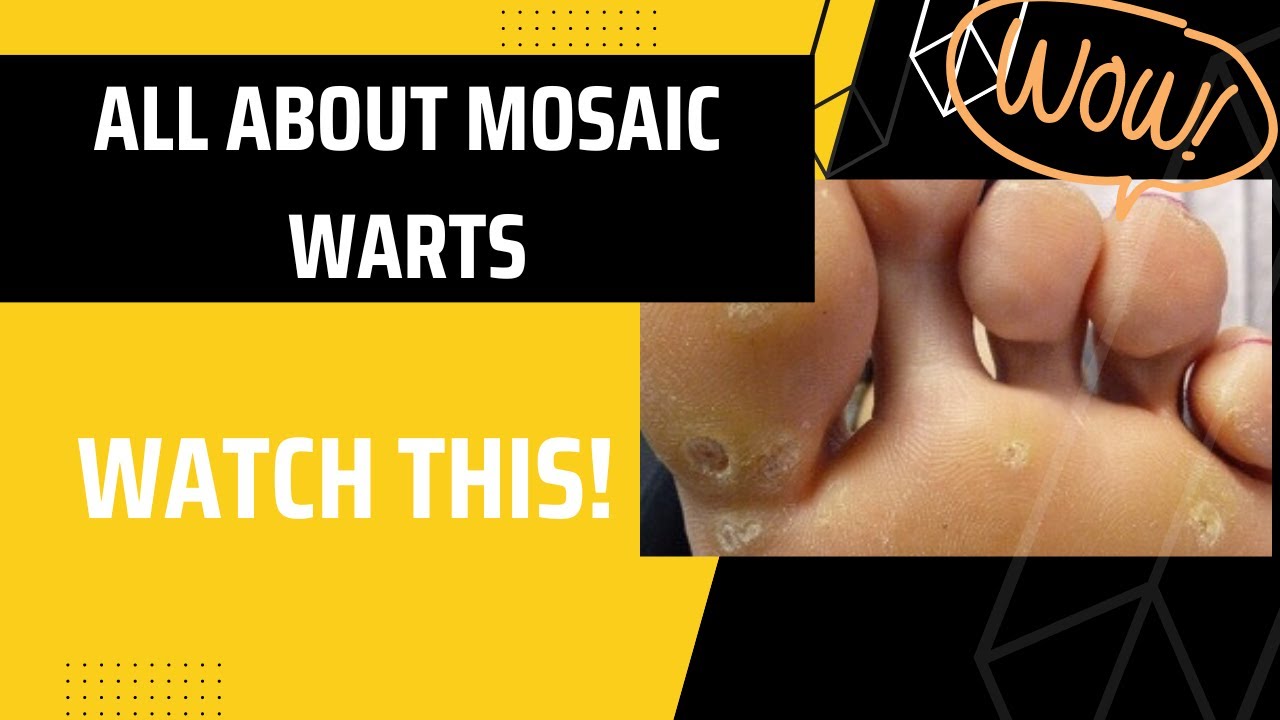 mosaic wart