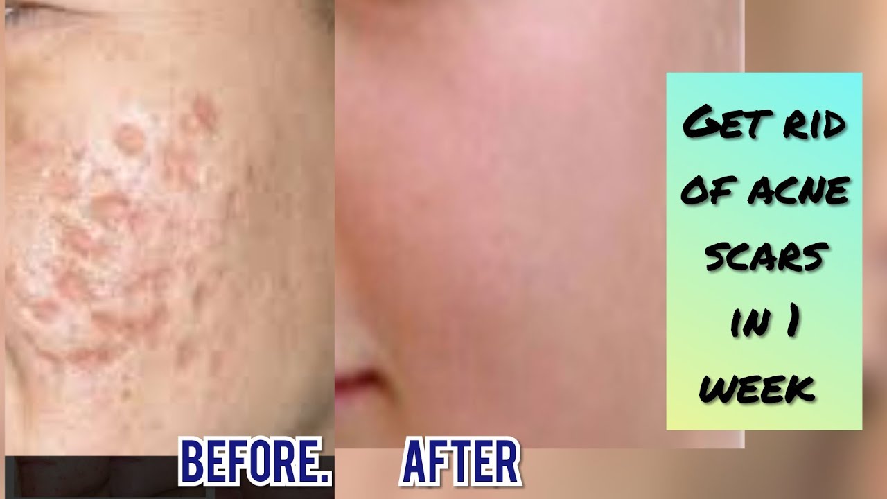 How to remove acne scars dark spots pimple marks Home remedy for