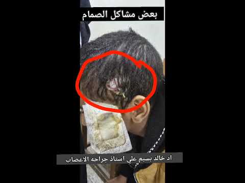 بعض مشاكل صمام المخ