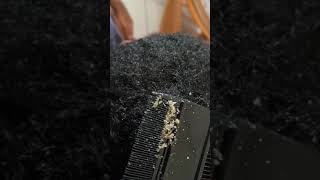 Dandruff combing short