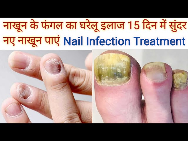 Top Homeopathy Medicines for Nail Fungus, Black Spots, Onycholysis